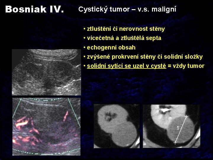 Bosniak IV. Cystický tumor – v. s. maligní • ztluštění či nerovnost stěny •