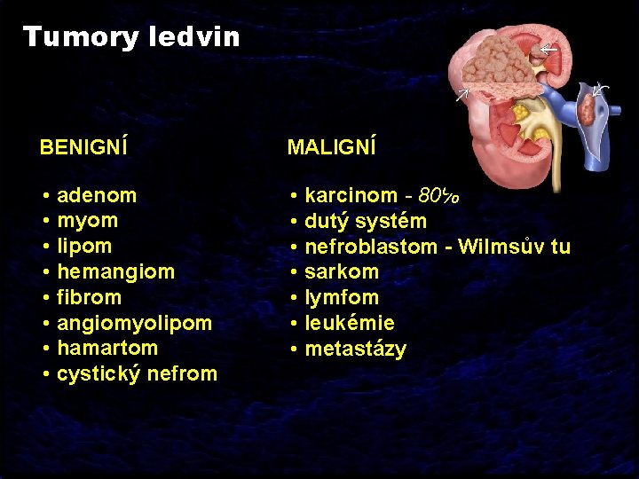 Tumory ledvin BENIGNÍ MALIGNÍ • adenom • myom • lipom • hemangiom • fibrom