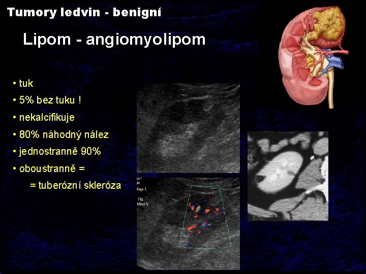 Tumory ledvin - benigní Lipom - angiomyolipom • tuk • 5% bez tuku !