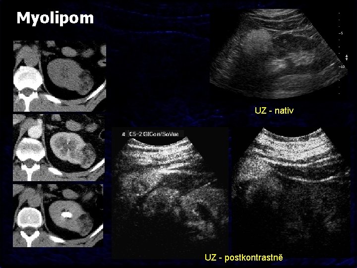 Myolipom UZ - nativ UZ - postkontrastně 