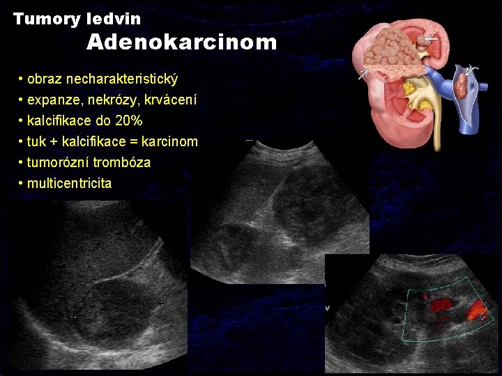 Tumory ledvin Adenokarcinom • obraz necharakteristický • expanze, nekrózy, krvácení • kalcifikace do 20%