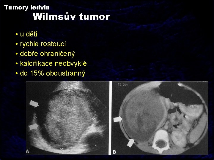Tumory ledvin Wilmsův tumor • u dětí • rychle rostoucí • dobře ohraničený •