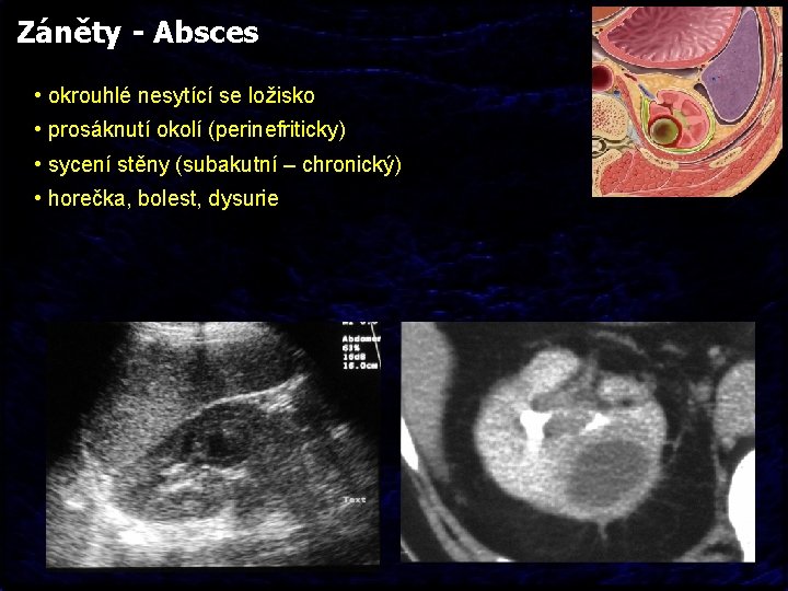 Záněty - Absces • okrouhlé nesytící se ložisko • prosáknutí okolí (perinefriticky) • sycení