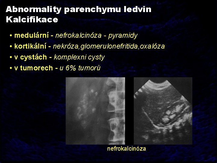 Abnormality parenchymu ledvin Kalcifikace • medulární - nefrokalcinóza - pyramidy • kortikální - nekróza,