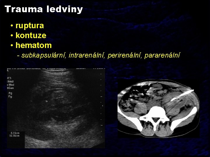 Trauma ledviny • ruptura • kontuze • hematom - subkapsulární, intrarenální, perirenální, pararenální 