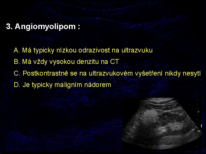 3. Angiomyolipom : A. Má typicky nízkou odrazivost na ultrazvuku B. Má vždy vysokou