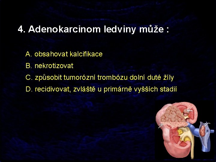 4. Adenokarcinom ledviny může : A. obsahovat kalcifikace B. nekrotizovat C. způsobit tumorózní trombózu