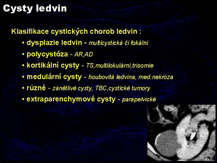 Cysty ledvin Klasifikace cystických chorob ledvin : • dysplazie ledvin - multicystická či fokální