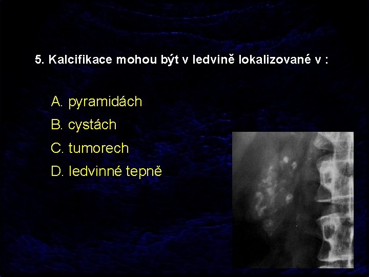5. Kalcifikace mohou být v ledvině lokalizované v : A. pyramidách B. cystách C.