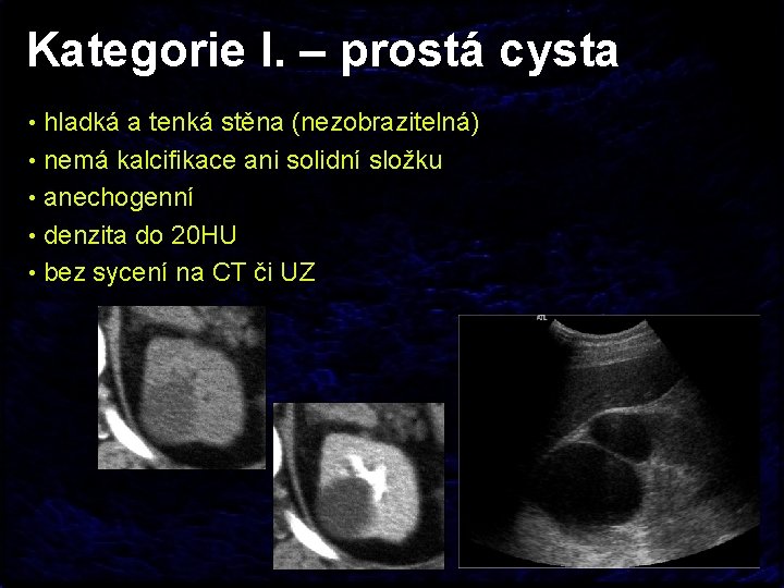 Kategorie I. – prostá cysta • hladká a tenká stěna (nezobrazitelná) • nemá kalcifikace