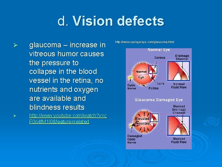 d. Vision defects Ø glaucoma – increase in vitreous humor causes the pressure to