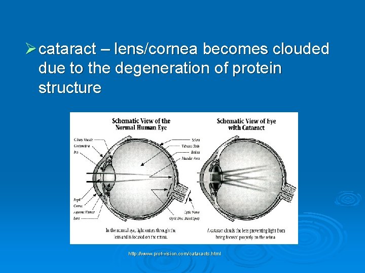 Ø cataract – lens/cornea becomes clouded due to the degeneration of protein structure http: