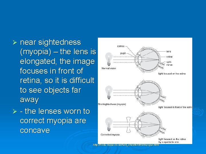 near sightedness (myopia) – the lens is elongated, the image focuses in front of
