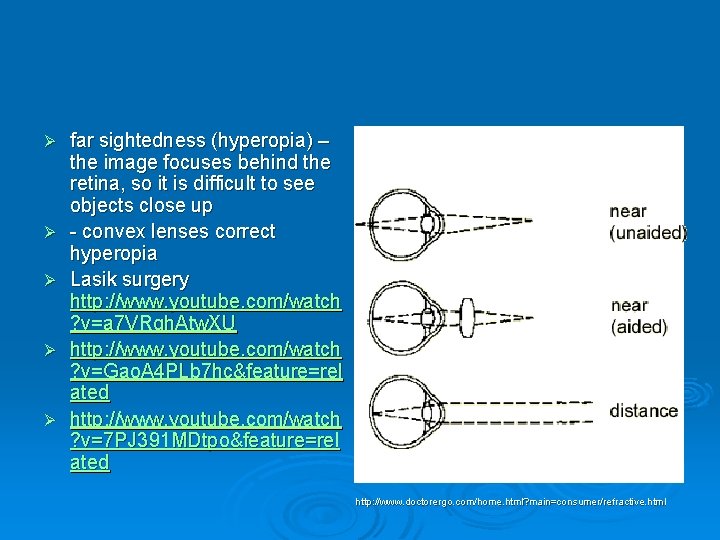 Ø Ø Ø far sightedness (hyperopia) – the image focuses behind the retina, so