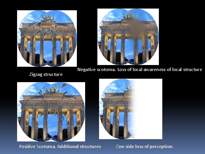 Zigzag structure Negative scotoma. Loss of local awareness of local structure Positive Scotoma. Additional