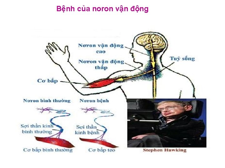 Bệnh của noron vận động 