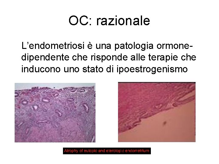 OC: razionale L’endometriosi è una patologia ormonedipendente che risponde alle terapie che inducono uno
