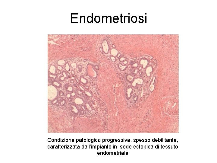 Endometriosi Condizione patologica progressiva, spesso debilitante, caratterizzata dall’impianto in sede ectopica di tessuto endometriale