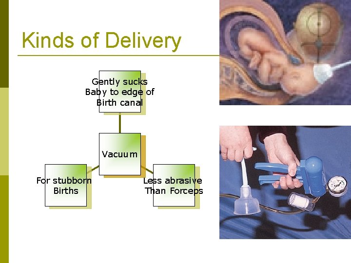 Kinds of Delivery Gently sucks Baby to edge of Birth canal Vacuum For stubborn