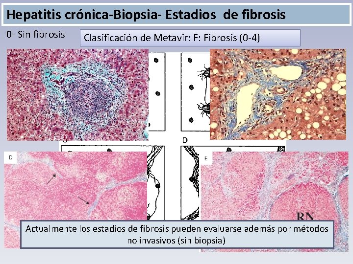 Hepatitis crónica-Biopsia- Estadios de fibrosis 0 - Sin fibrosis Clasificación de Metavir: F: Fibrosis