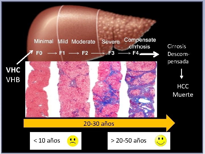 Cirrosis Descompensada VHC VHB VH HCC Muerte 20 -30 años < 10 años >