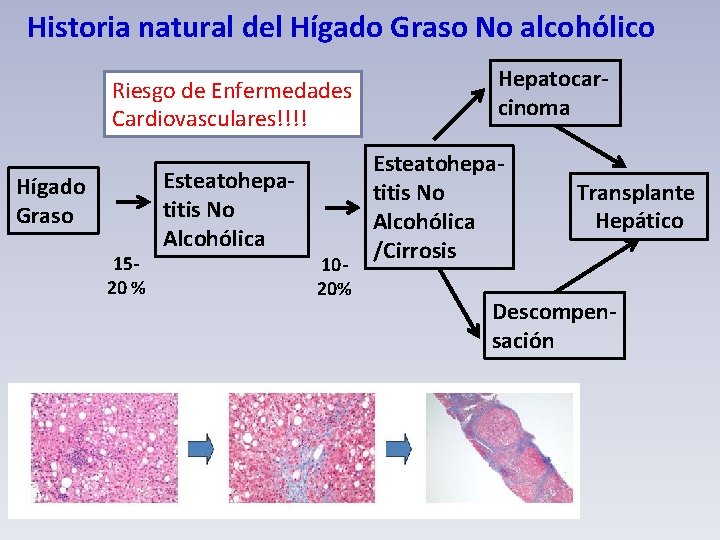 Historia natural del Hígado Graso No alcohólico Riesgo de Enfermedades Cardiovasculares!!!! Hígado Graso 1520