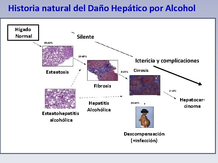 Historia natural del Daño Hepático por Alcohol Hígado Normal Silente Ictericia y complicaciones Cirrosis