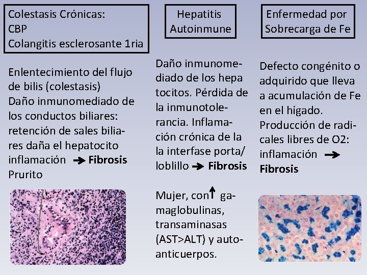Colestasis Crónicas: CBP Colangitis esclerosante 1 ria Enlentecimiento del flujo de bilis (colestasis) Daño