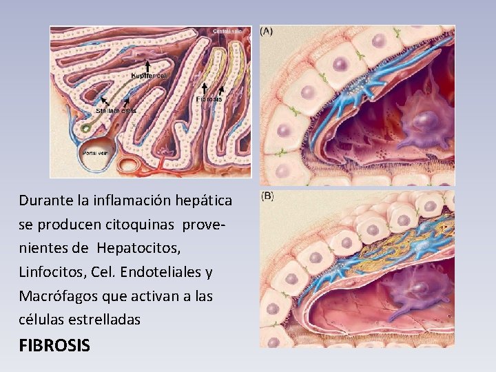 Durante la inflamación hepática se producen citoquinas provenientes de Hepatocitos, Linfocitos, Cel. Endoteliales y