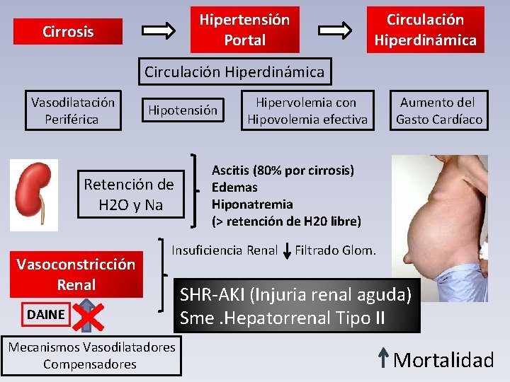 Hipertensión Portal Cirrosis Circulación Hiperdinámica Vasodilatación Periférica Hipotensión Retención de H 2 O y