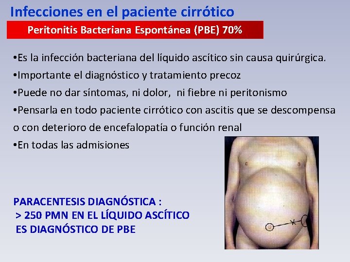 Infecciones en el paciente cirrótico Peritonitis Bacteriana Espontánea (PBE) 70% • Es la infección
