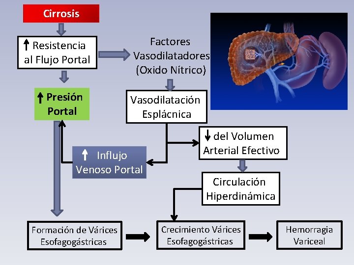 Cirrosis Resistencia al Flujo Portal Presión Portal Factores Vasodilatadores (Oxido Nítrico) Vasodilatación Esplácnica Influjo