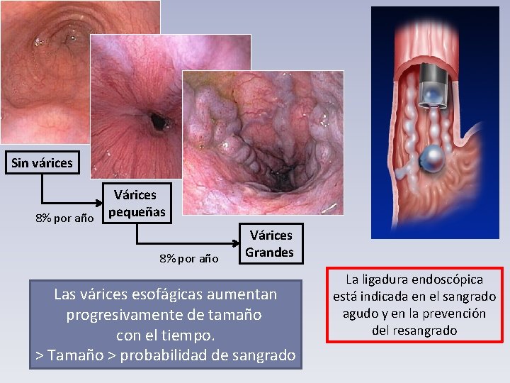 Sin várices 8% por año Várices pequeñas 8% por año Várices Grandes Las várices