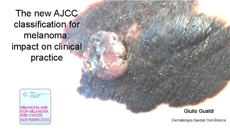 The new AJCC classification for melanoma: impact on clinical practice Giulio Gualdi Dermatologia Spedali