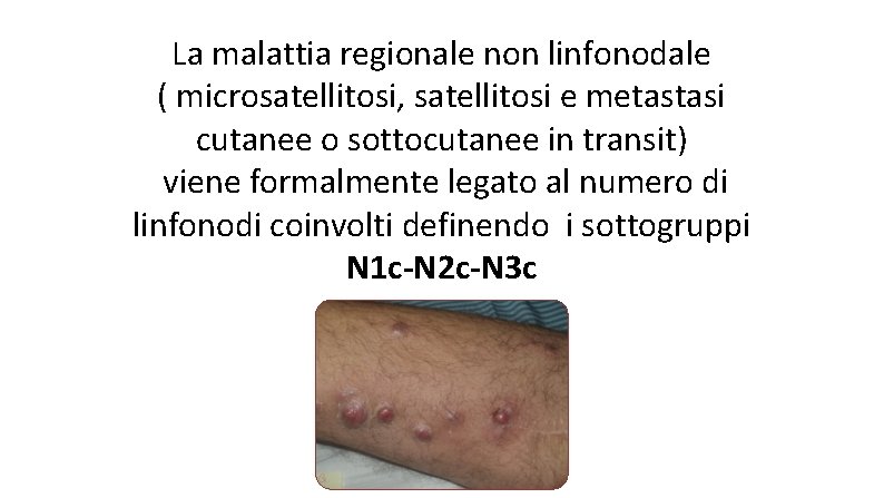 La malattia regionale non linfonodale ( microsatellitosi, satellitosi e metastasi cutanee o sottocutanee in