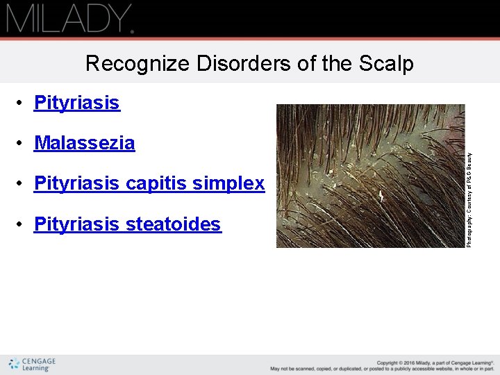 Recognize Disorders of the Scalp • Malassezia • Pityriasis capitis simplex • Pityriasis steatoides