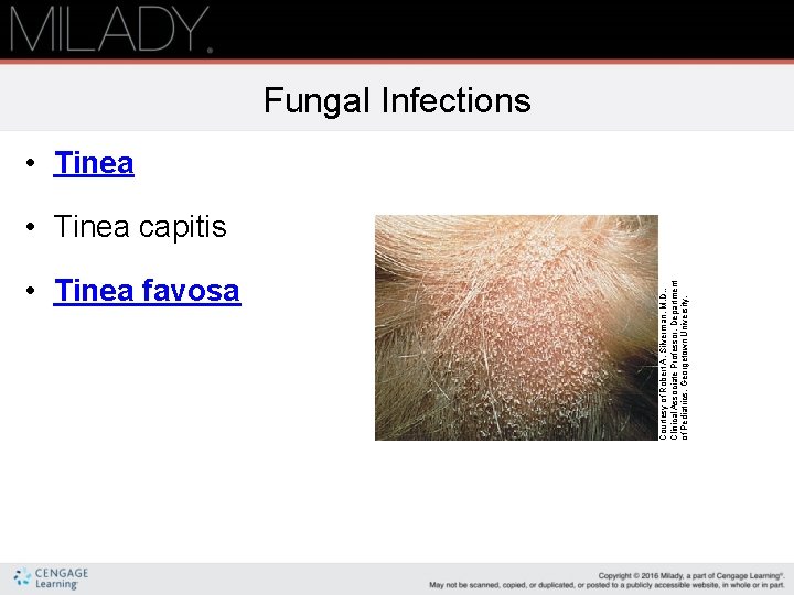  • Tinea favosa Courtesy of Robert A. Silverman, M. D. , Clinical Associate