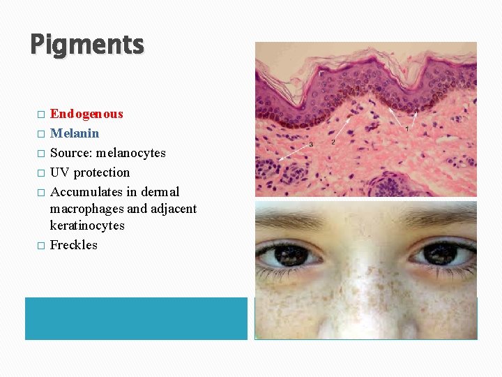 Pigments � � � Endogenous Melanin Source: melanocytes UV protection Accumulates in dermal macrophages