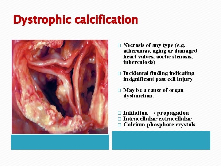 Dystrophic calcification � Necrosis of any type (e. g. atheromas, aging or damaged heart