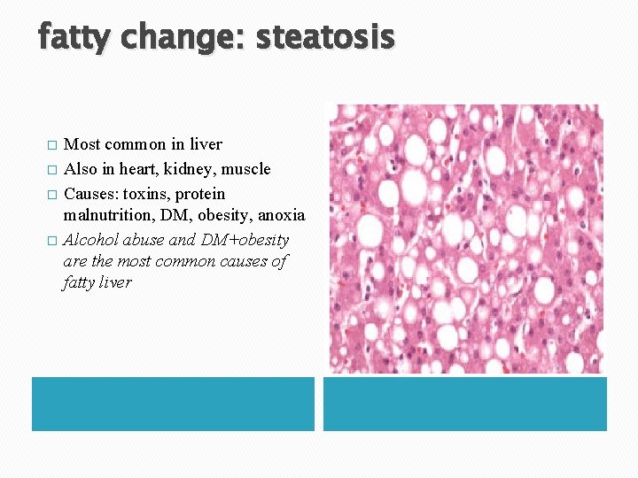fatty change: steatosis � � Most common in liver Also in heart, kidney, muscle