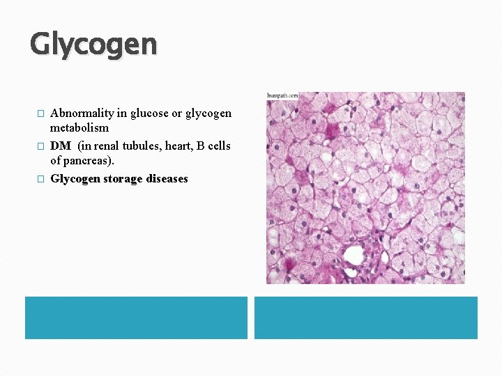 Glycogen � � � Abnormality in glucose or glycogen metabolism DM (in renal tubules,