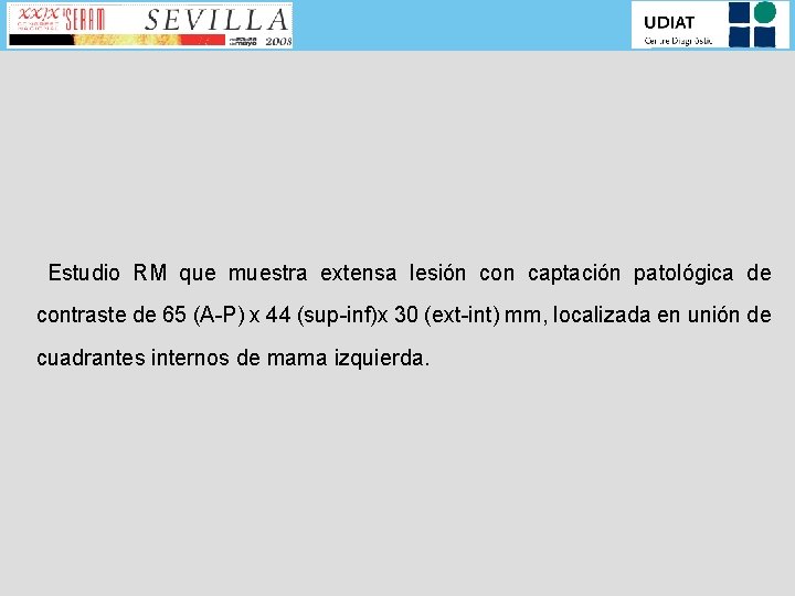 Estudio RM que muestra extensa lesión con captación patológica de contraste de 65 (A-P)