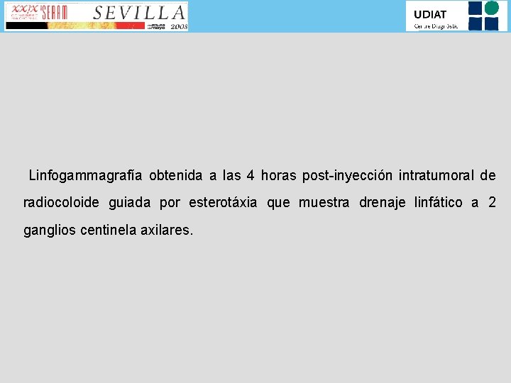 Linfogammagrafía obtenida a las 4 horas post-inyección intratumoral de radiocoloide guiada por esterotáxia que