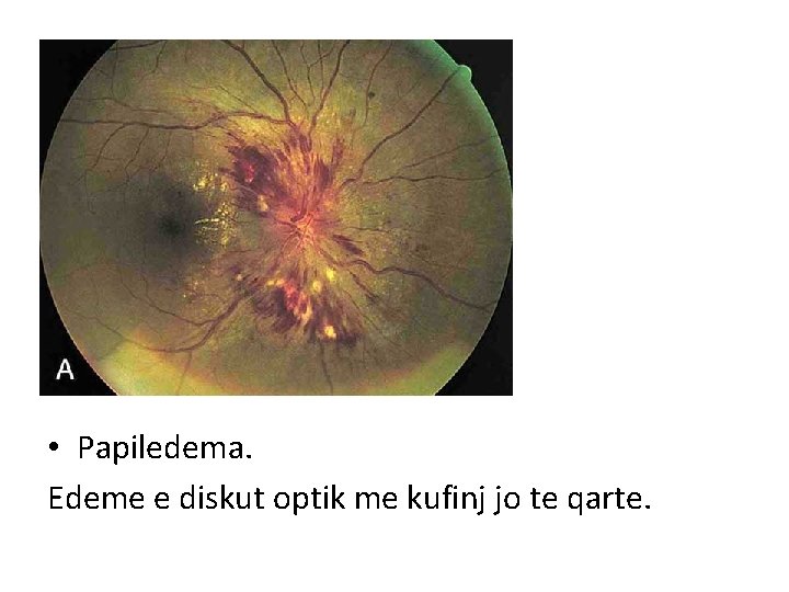  • Papiledema. Edeme e diskut optik me kufinj jo te qarte. 