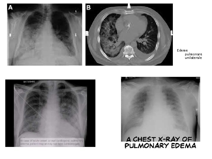 Edeme pulmonare unilaterale 