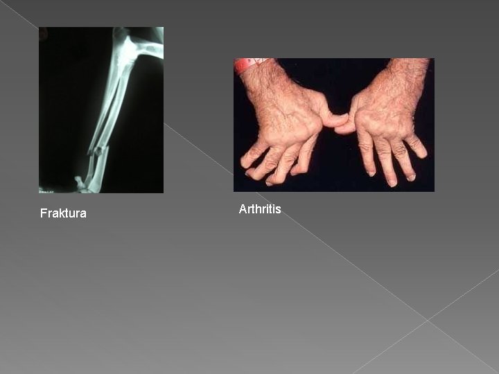 Fraktura Arthritis 