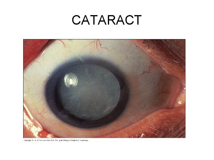 CATARACT 