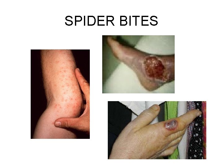 SPIDER BITES 