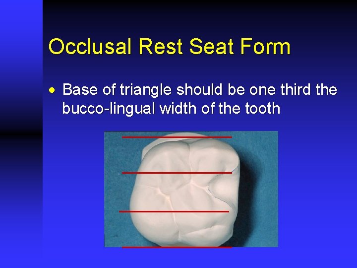 Occlusal Rest Seat Form · Base of triangle should be one third the bucco-lingual