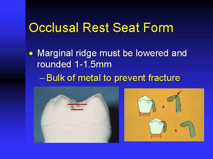 Occlusal Rest Seat Form · Marginal ridge must be lowered and rounded 1 -1.